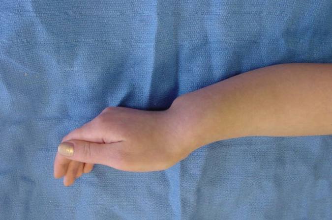 Madelung's Deformity - observation | Hand Surgery Source